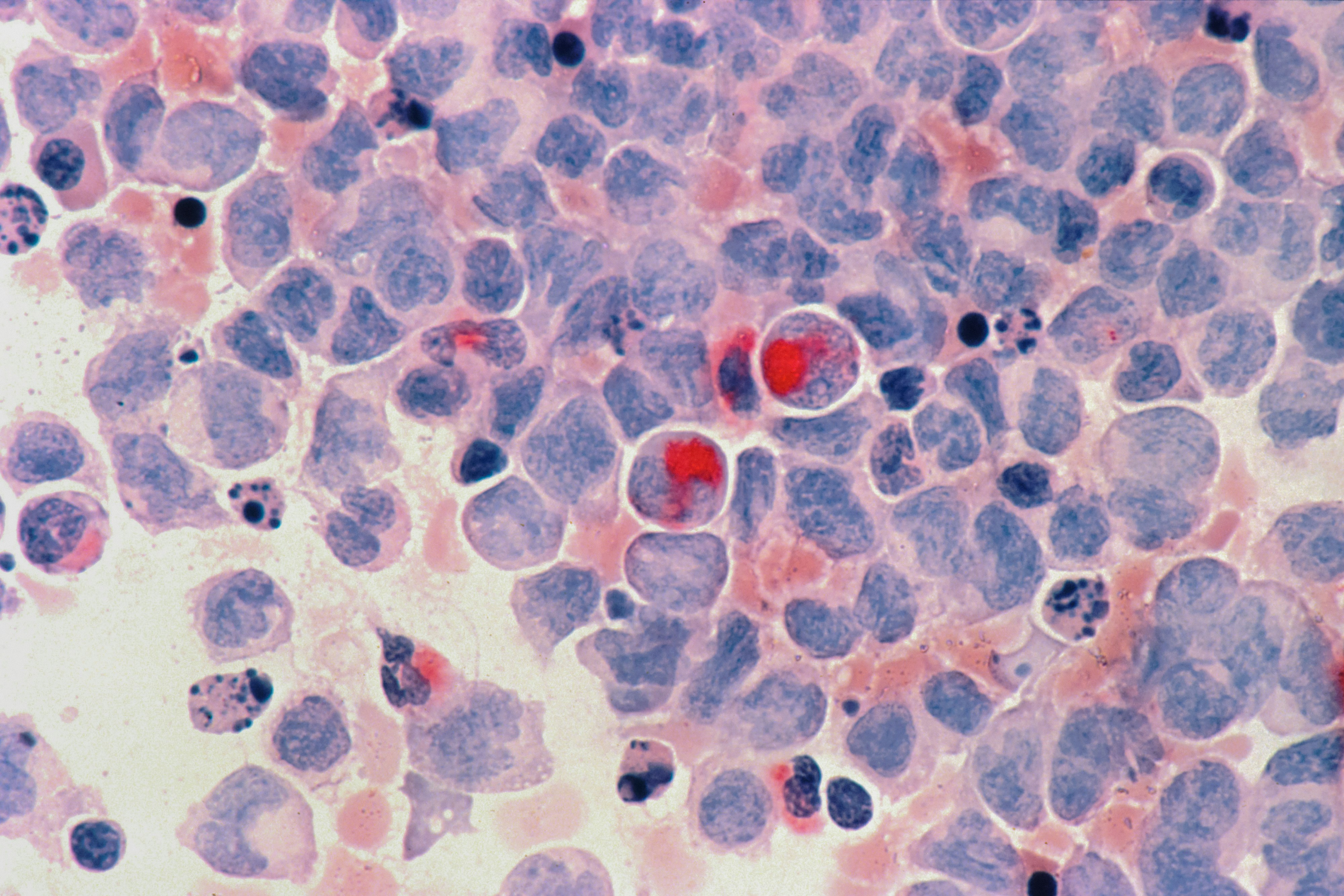 Leukemia ( Blood Cancer)