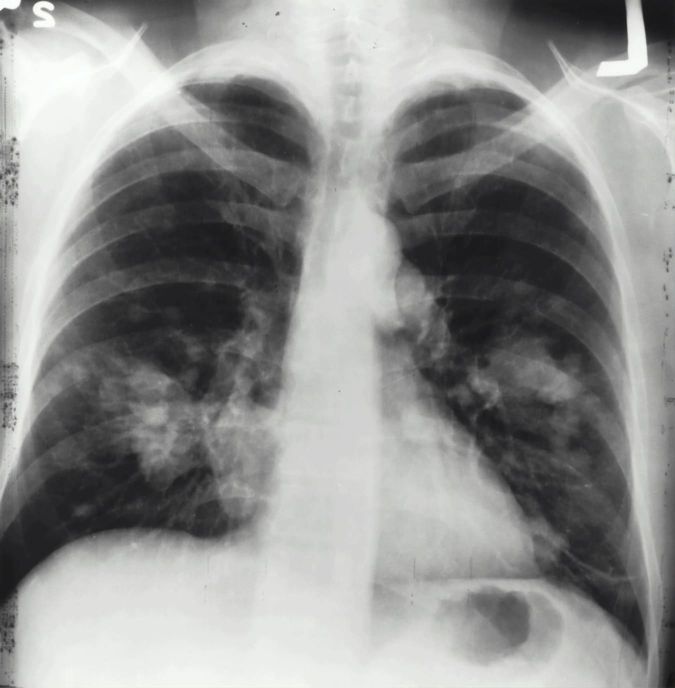 Lung Cancer in Malaysia -Sixth Top Killer in Malaysia