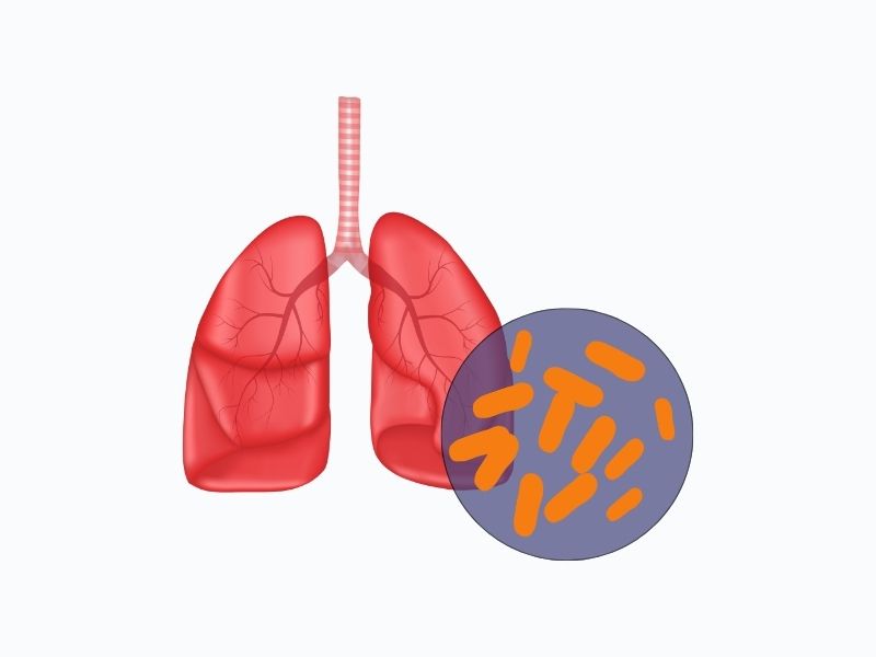 Tuberculosis