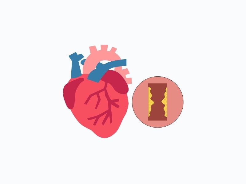 Ischemic Heart Disease