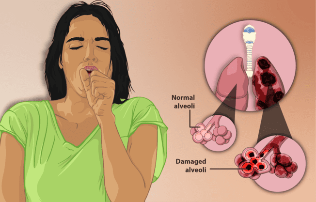 SILENT BUT DEADLY-CHRONIC OBSTRUCTIVE PULMONARY DISEASE