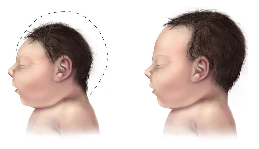 Congenital Brain Defect