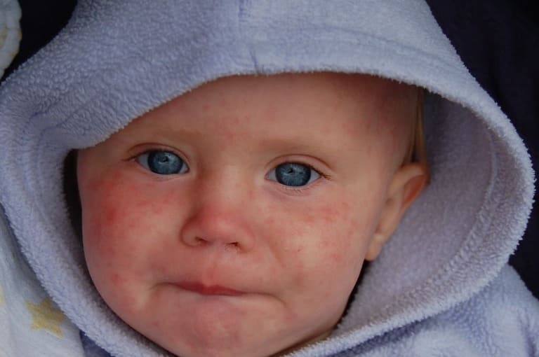 MEASLES DISEASE