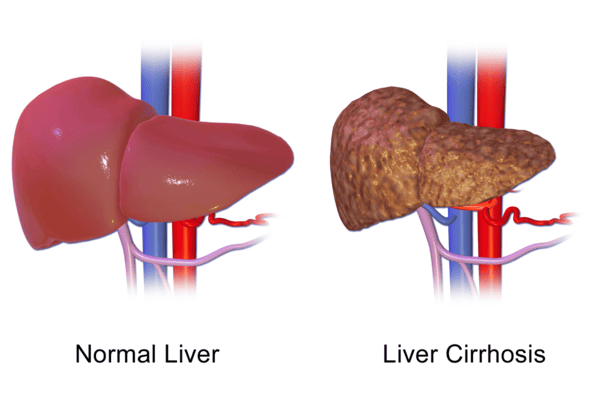 Cirrhosis- A Common Disease In Chile